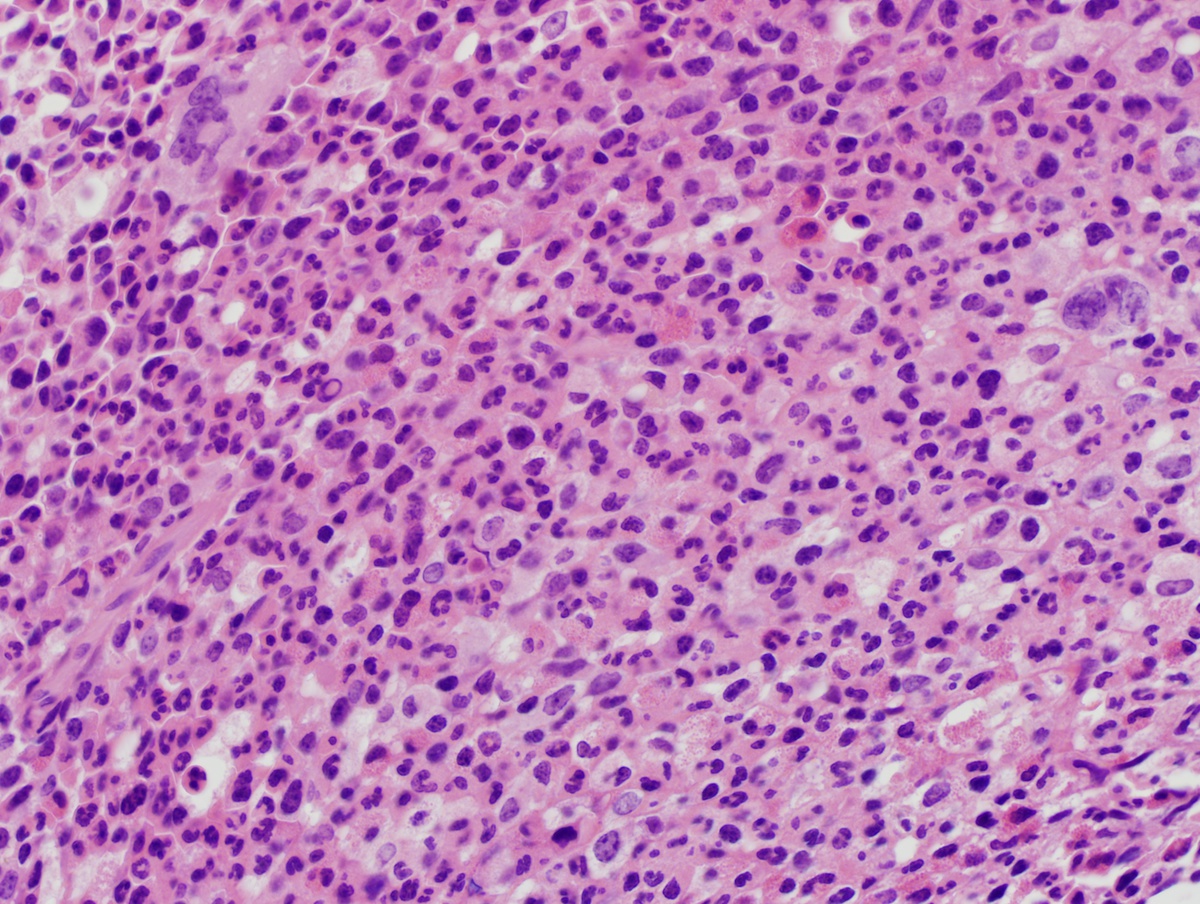 BM biopsy 1 core 50x
